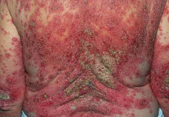 Le ragioni di eczema sono una pressione