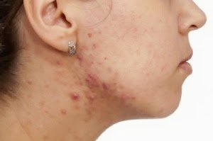 Siccome è possibile guarire posti sulla faccia e un dorso